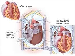 heart transplant_1 &